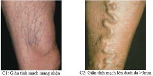 Suy Giãn Tĩnh Mạch Chi Dưới